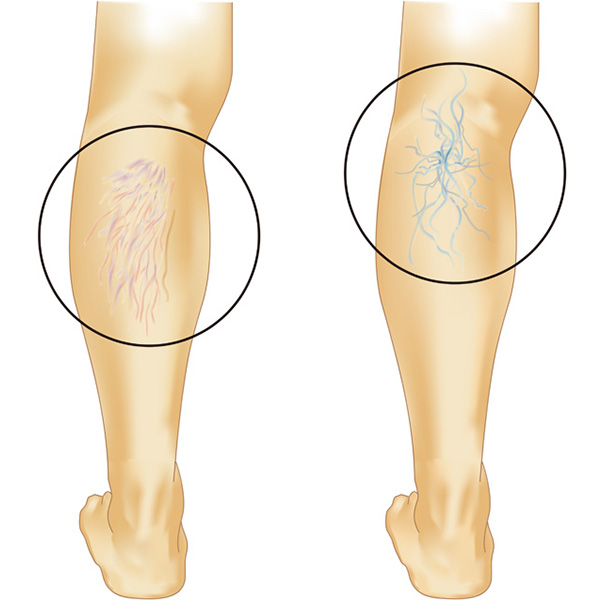 下肢静脈瘤の代表的なタイプ