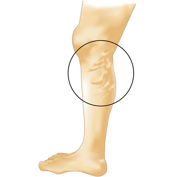 下肢静脈瘤の代表的なタイプ