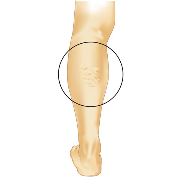 下肢静脈瘤の代表的なタイプ
